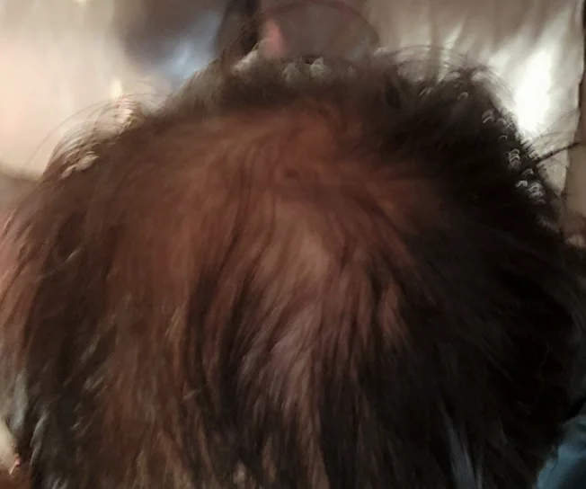 3,500 grafts