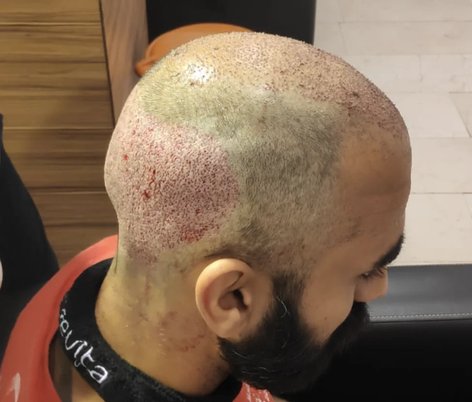 Bald Head