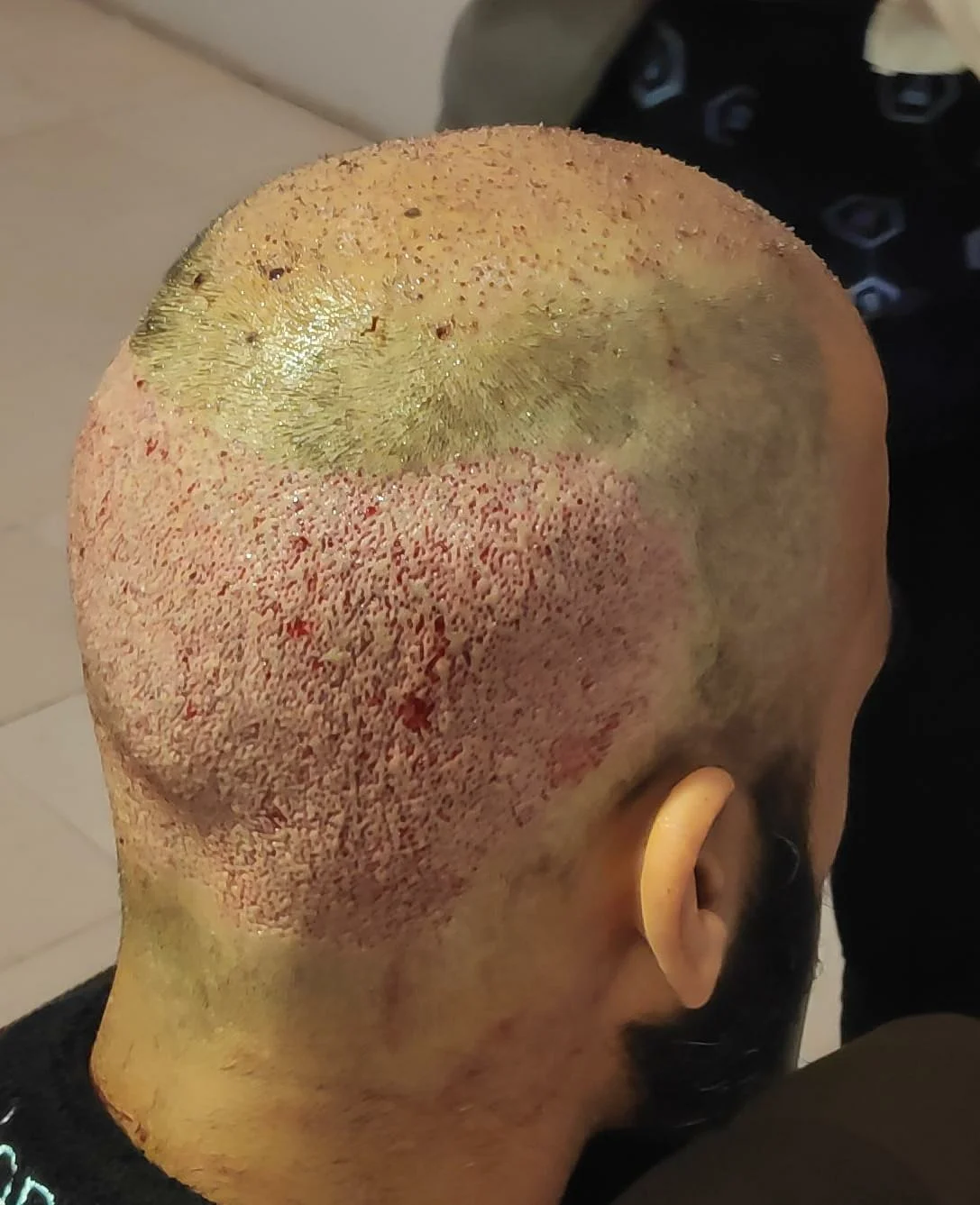Bald Head