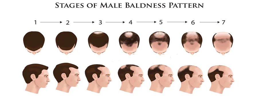 Male Blindness Pattern